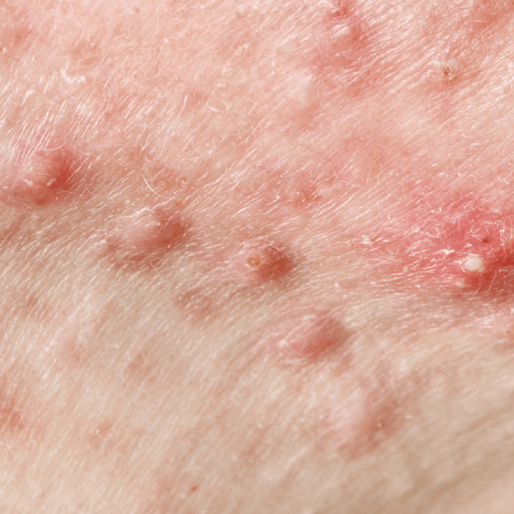 Behandeling tegen Acne