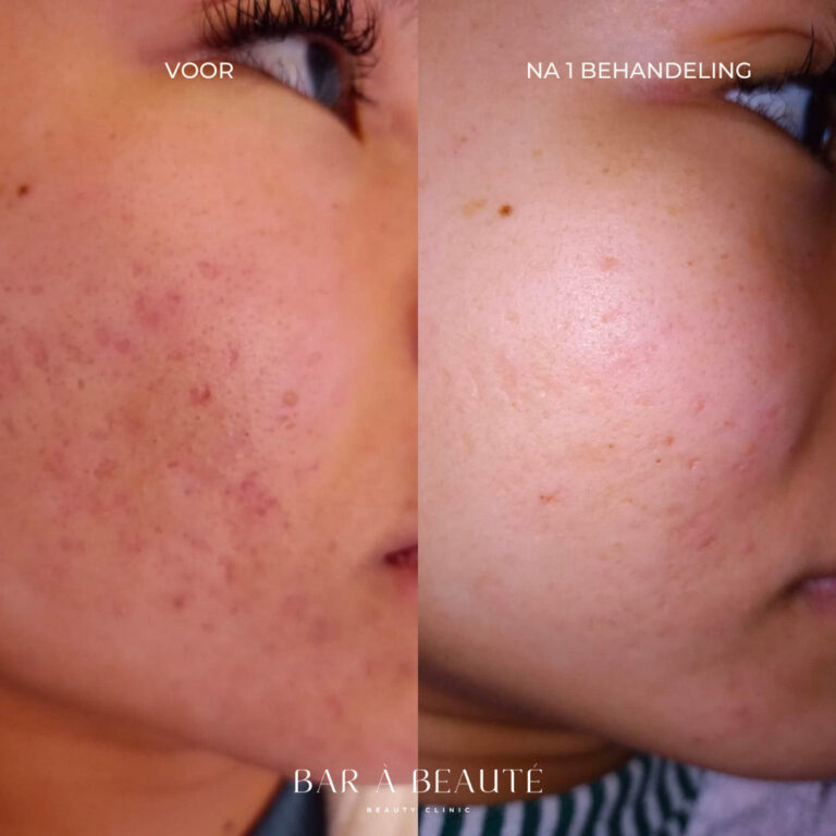 Littekens behandelen I Bar à Beauté Beauty Clinic
