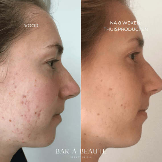 De oorzaak van Acné