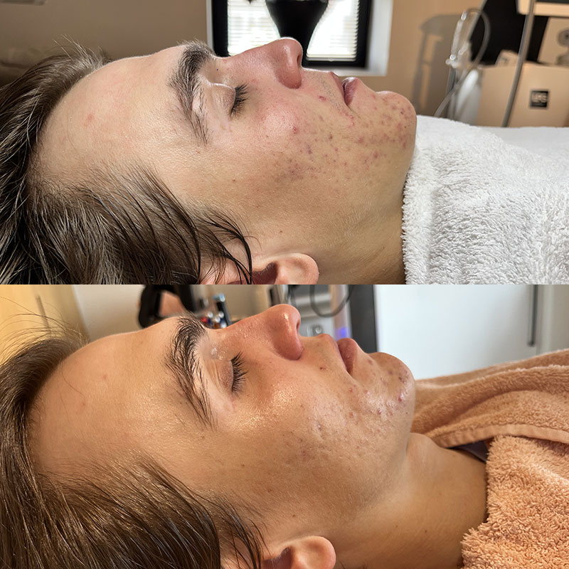 Voor en na chemische peeling acne