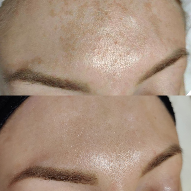 Voor en na foto skinpen hyperpigmentatie