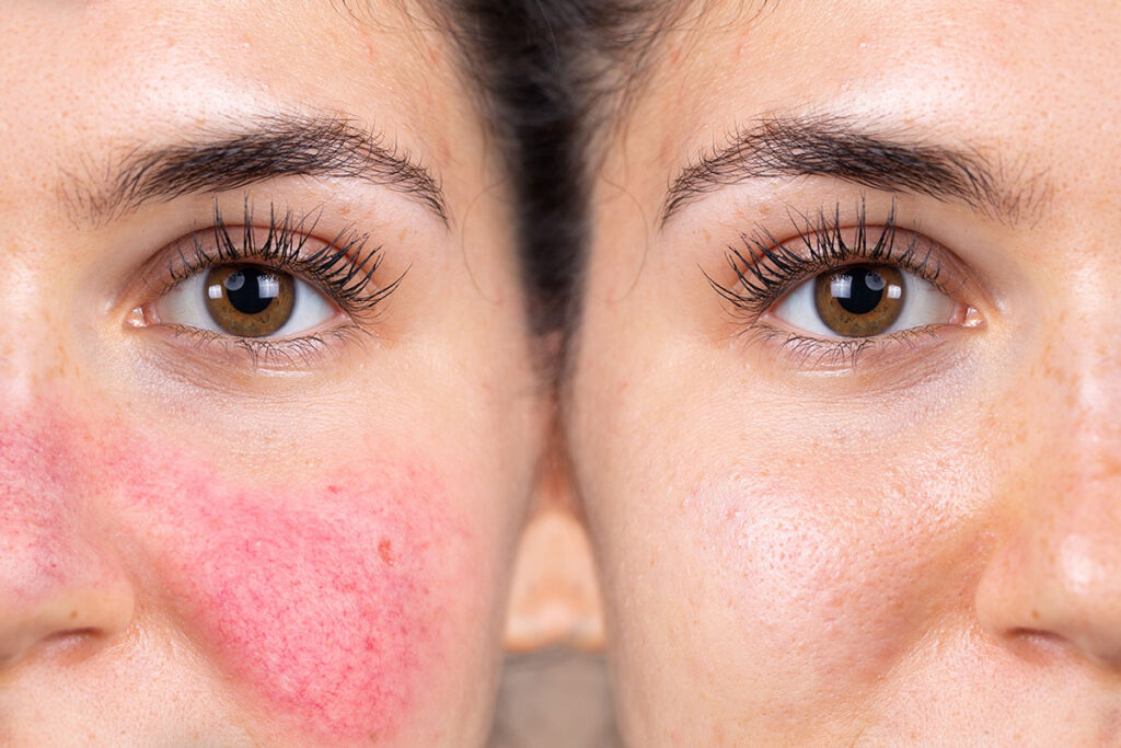 Rosacea en couperose zijn twee huidaandoeningen die roodheid kunnen veroorzaken.