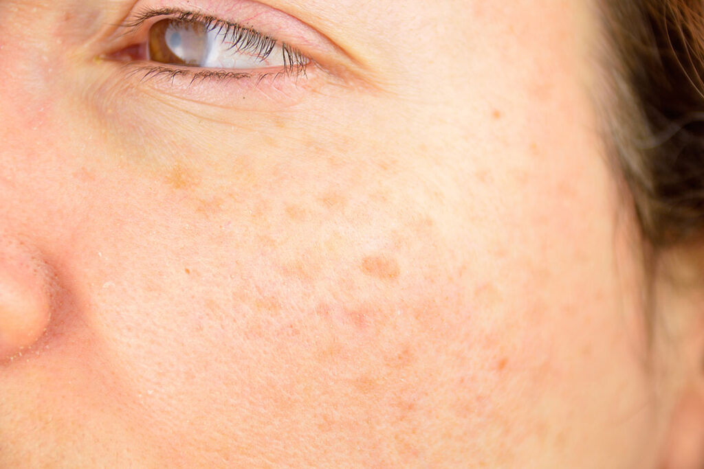 Hyperpigmentatie op je gezicht, bovenlip en oksel