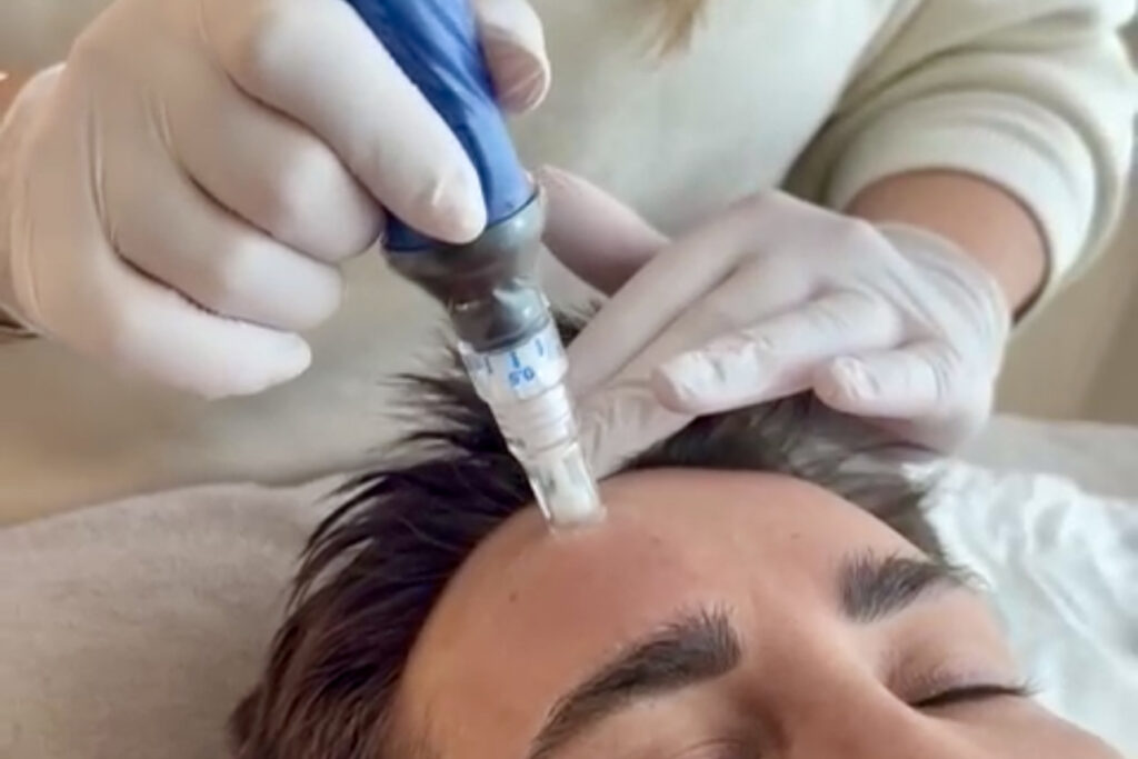 SkinPen microneedling behandeling bij Bar à Beauté in Knokke voor stimulatie van collageen en verfijning van de huidstructuur